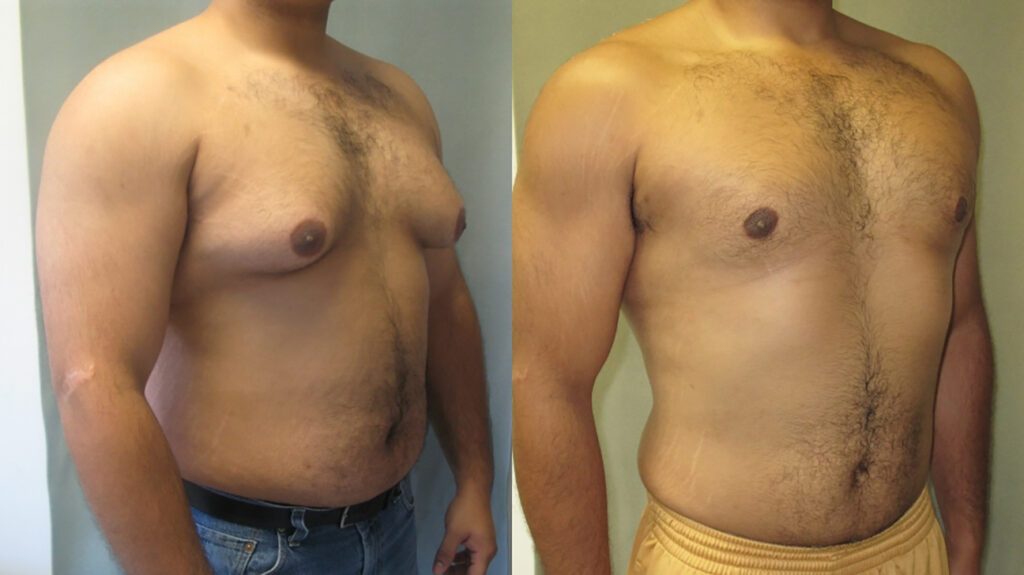 Gynecomastia treatment Melbourne