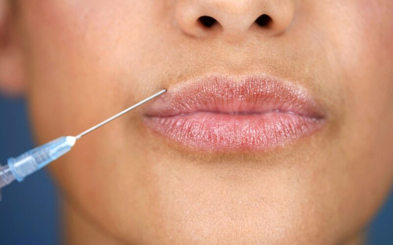 What Are Injectable Facial Fillers?