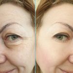 deep plane facelift surgery